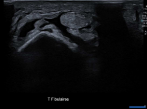 Rupture Rétinaclum Fibulaire