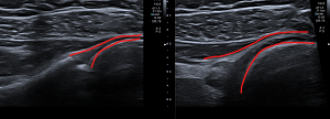 Avant / Après capsulo distension