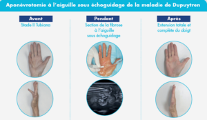 Dupuytren