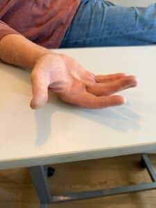 rétraction paume main Dupuytren