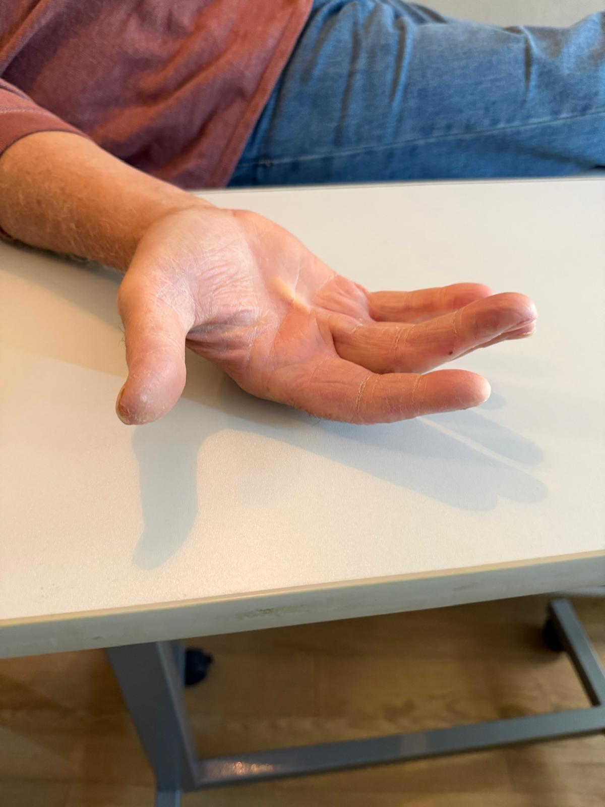 rétraction paume main Dupuytren